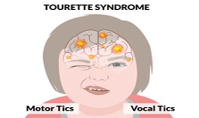 The Response of Placebos in Tourette’s Disorder: Insight from a Meta-Analysis